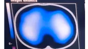 Imágenes de tomografía que se toman para analizar el desempeño de la fisioterapia con el inventivo Ubicu Imágenes de tomografía que se toman para analizar el desempeño de la fisioterapia con el inventivo Ubicu