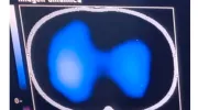Imágenes de tomografía que se toman para analizar el desempeño de la fisioterapia con el inventivo Ubicu Imágenes de tomografía que se toman para analizar el desempeño de la fisioterapia con el inventivo Ubicu