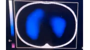 Imágenes de tomografía que se toman para analizar el desempeño de la fisioterapia con el inventivo Ubicu Imágenes de tomografía que se toman para analizar el desempeño de la fisioterapia con el inventivo Ubicu
