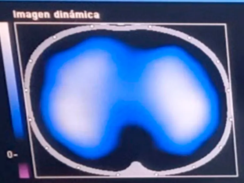 Imágenes de tomografía que se toman para analizar el desempeño de la fisioterapia con el inventivo Ubicu Imágenes de tomografía que se toman para analizar el desempeño de la fisioterapia con el inventivo Ubicu
